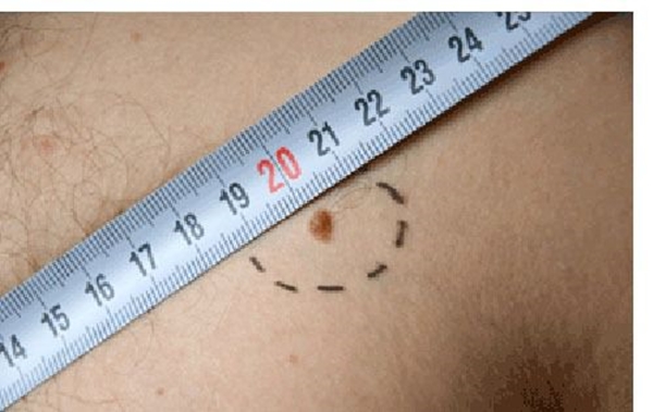 Foto - Kanserli ben nasıl anlaşılabilir?