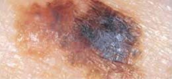 Foto - Kanserli ben nasıl anlaşılabilir?