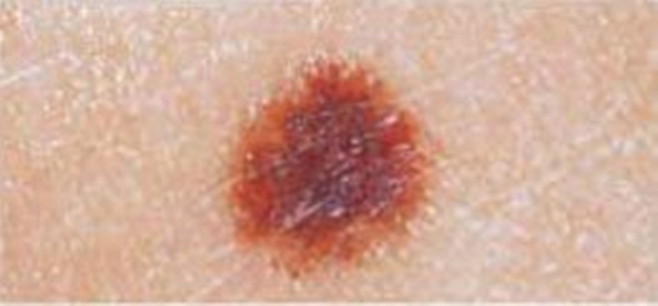 Foto - Kanserli ben nasıl anlaşılabilir?