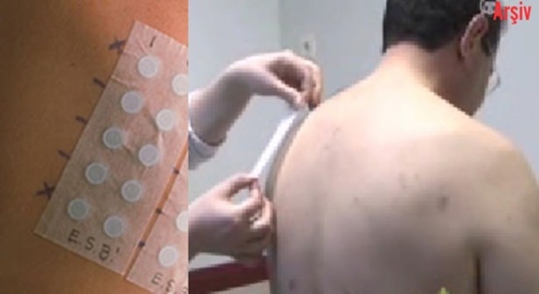 Foto - Kanserli ben nasıl anlaşılabilir?