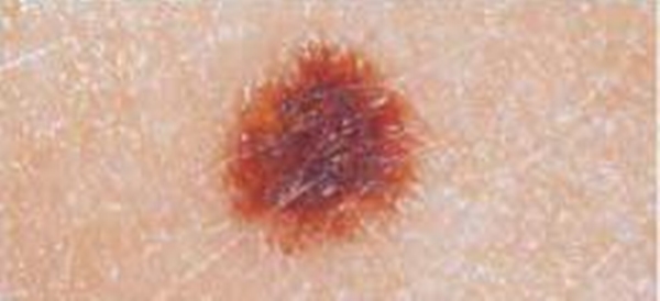 Foto - Kanserli ben nasıl anlaşılabilir?