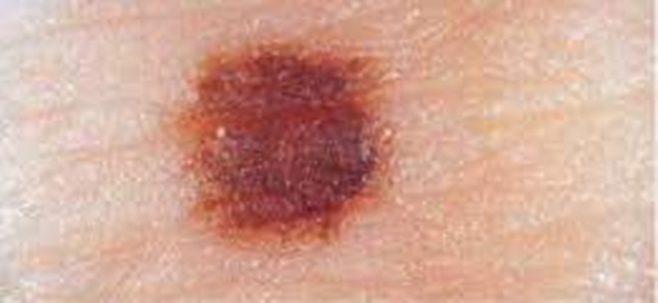 Foto - Kanserli ben nasıl anlaşılabilir?