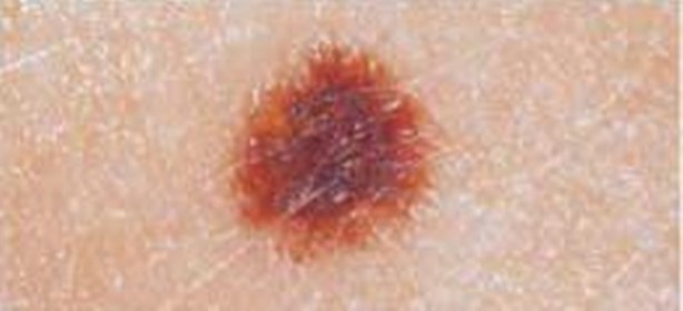 Foto - Kanserli ben nasıl anlaşılır?