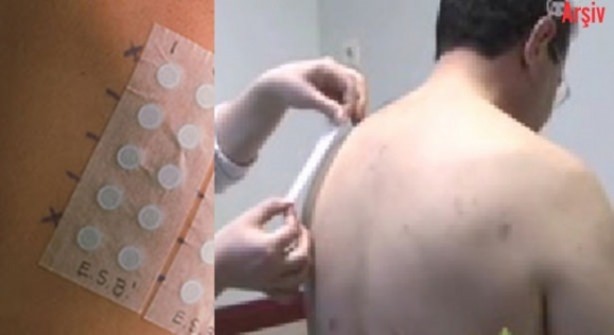 Foto - Kanserli ben nasıl anlaşılır?