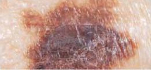 Foto - Kanserli ben nasıl anlaşılır?