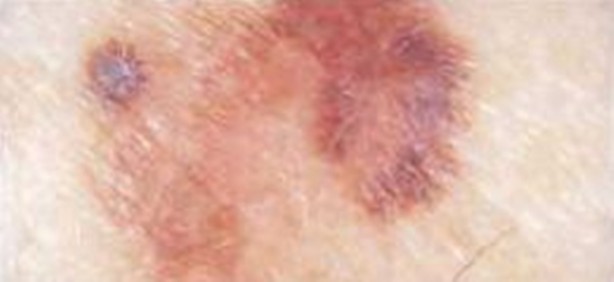 Foto - Kanserli ben nasıl anlaşılır?