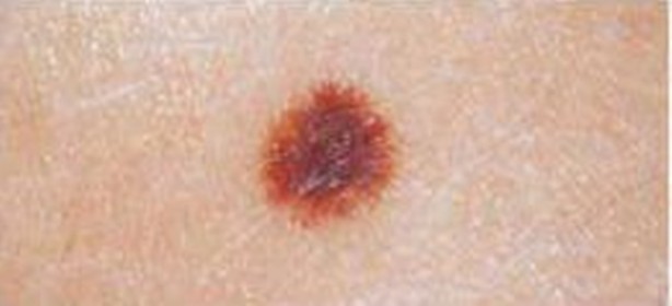 Foto - Kanserli ben nasıl anlaşılır?