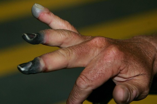 Kara aldanıp soğuk yanığı olmayın Bu belirtilere dikkat!