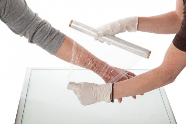 Foto - Kara aldanıp soğuk yanığı olmayın Bu belirtilere dikkat!