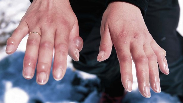 Foto - Kara aldanıp soğuk yanığı olmayın Bu belirtilere dikkat!