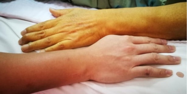 Foto - Karaciğer yağlanması ne demektir? Belirtileri nelerdir?