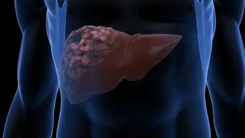 Foto - Karaciğerde ölüme götüren risk! Uzman isim tek tedavisini açıkladı