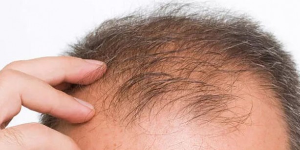 Foto - Karanfilin saç için faydalı olduğunu biliyor muydunuz? Karanfilin saçlara 9 faydası! 