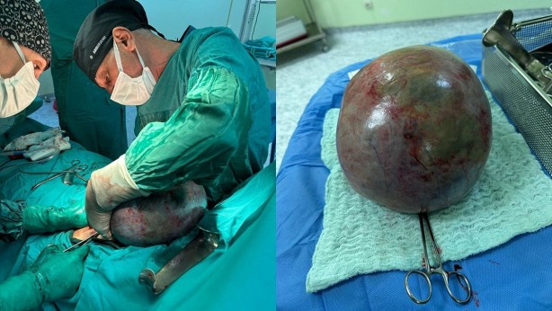 Karın ağrısı şikayetiyle doktora gitti, hayatının şokunu yaşadı: Tamı tamına 10 kilo! "Yok artık" diyeceksiniz