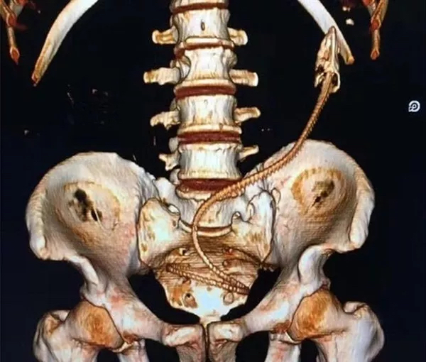 Foto - Karnından ameliyatla canlı yılan balığı çıkarıldı! Vücuduna girdiği yer ise herkesi şaşkına çevirdi