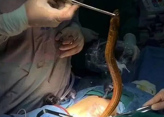 Karnından ameliyatla canlı yılan balığı çıkarıldı! Vücuduna girdiği yer ise herkesi şaşkına çevirdi
