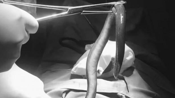 Foto - Karnından ameliyatla canlı yılan balığı çıkarıldı! Vücuduna girdiği yer ise herkesi şaşkına çevirdi