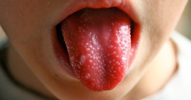 Kawasaki hastalığı nedir? Kawasaki hastalığı belirtileri nelerdir? Kawasaki hastalığı ile koronavirüs arasındaki bağlantı nedir?