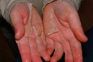 Foto - Kawasaki hastalığı nedir? Kawasaki hastalığı belirtileri nelerdir? Kawasaki hastalığı ile koronavirüs arasındaki bağlantı nedir?