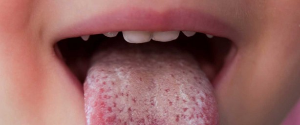 Foto - Kawasaki hastalığı nedir? Kawasaki hastalığı belirtileri nelerdir? Kawasaki hastalığı ile koronavirüs arasındaki bağlantı nedir?