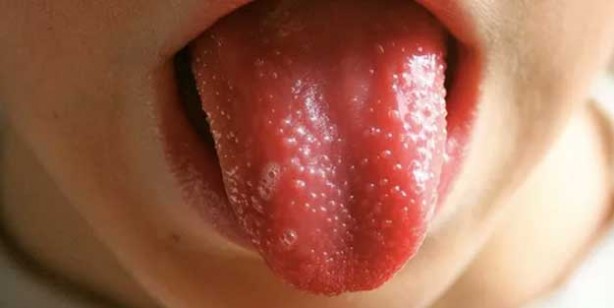 Foto - Kawasaki hastalığı nedir? Kawasaki hastalığı belirtileri nelerdir? Kawasaki hastalığı ile koronavirüs arasındaki bağlantı nedir?