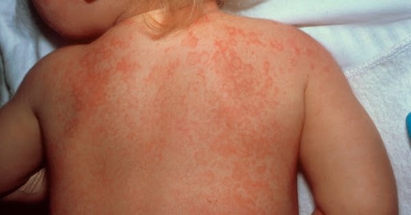 Foto - Kawasaki hastalığı nedir? Kawasaki hastalığı belirtileri nelerdir? Kawasaki hastalığı ile koronavirüs arasındaki bağlantı nedir?