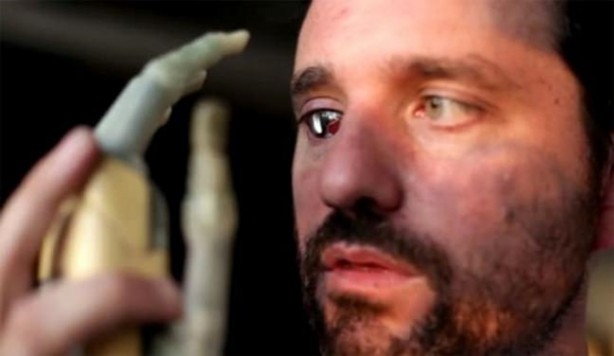 Foto - Kaybettiği gözünün yerine bakın ne yaptı!