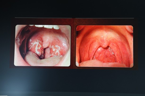 Foto - KBB Uzmanı Op. Dr. Özer: ''Kronik farenjit, özellikle yaz aylarında problem oluşturuyor''