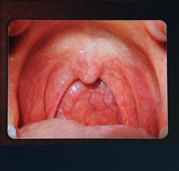 KBB Uzmanı Op. Dr. Özer: ''Kronik farenjit, özellikle yaz aylarında problem oluşturuyor''