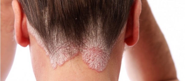 Foto - Keçi sütü sabunuyla siyah noktalardan kurtulun