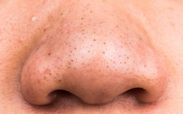 Foto - Keçi sütü sabunuyla siyah noktalardan kurtulun