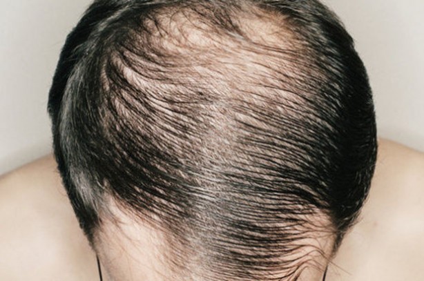 Foto - Kel kalmak istemiyorsanız bu içeceklerden uzak durun