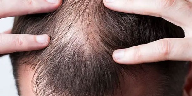 Foto - Kel kalmak istemiyorsanız bu içeceklerden uzak durun