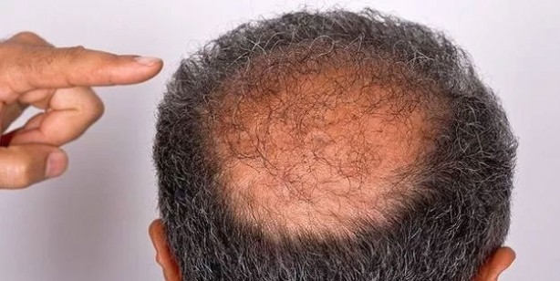 Foto - Kel kalmak istemiyorsanız bu içeceklerden uzak durun