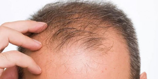 Kel kalmak istemiyorsanız bu içeceklerden uzak durun