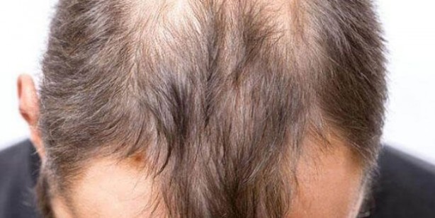 Foto - Kel kalmak istemiyorsanız bu içeceklerden uzak durun