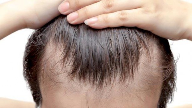 Foto - Kel kalmak istemiyorsanız bu içeceklerden uzak durun