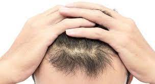 Foto - Kel kalmak istemiyorsanız bu içeceklerden uzak durun