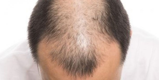 Foto - Kel kalmak istemiyorsanız bu içeceklerden uzak durun