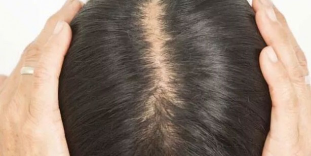 Foto - Kel kalmak istemiyorsanız bu içeceklerden uzak durun