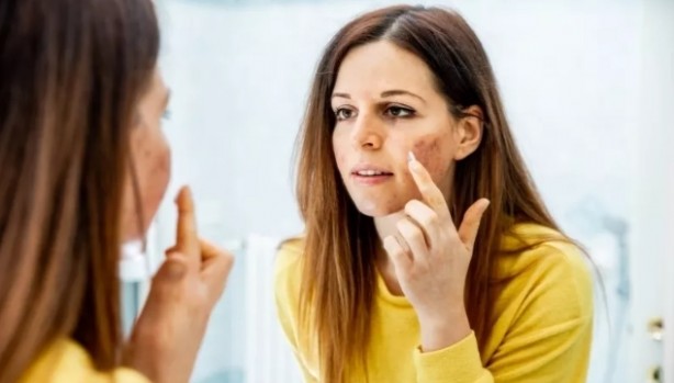 Foto - Kellik için birebir! Günde 1 fincan yetiyor