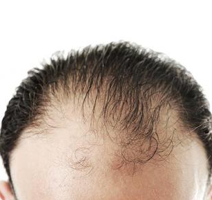 Foto - Kellik tedavisi için sarımsak kürleri: İşimize yarar mı? Saçı dökülen ve kepek sorunu yaşayanların dikkatine