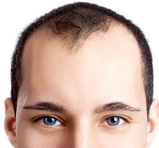 Foto - Kellik tedavisi için sarımsak kürleri: İşimize yarar mı? Saçı dökülen ve kepek sorunu yaşayanların dikkatine