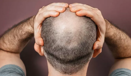 Foto - Kellik tedavisi için sarımsak kürleri: İşimize yarar mı? Saçı dökülen ve kepek sorunu yaşayanların dikkatine