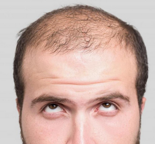 Foto - Kellik tedavisi için sarımsak kürleri: İşimize yarar mı? Saçı dökülen ve kepek sorunu yaşayanların dikkatine