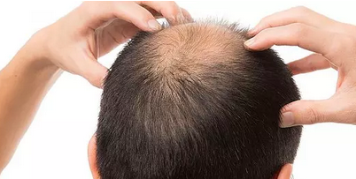 Kellik tedavisi için sarımsak kürleri: İşimize yarar mı? Saçı dökülen ve kepek sorunu yaşayanların dikkatine