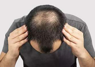 Foto - Kellik tedavisi için sarımsak kürleri: İşimize yarar mı? Saçı dökülen ve kepek sorunu yaşayanların dikkatine