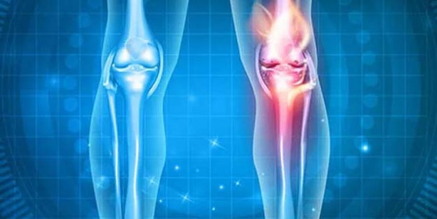 Foto - Kemik erimesine deva olan kür