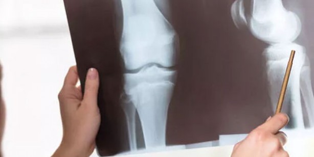 Foto - Kemik ve diş sağlığı için kalsiyum zengini en iyi 13 gıda