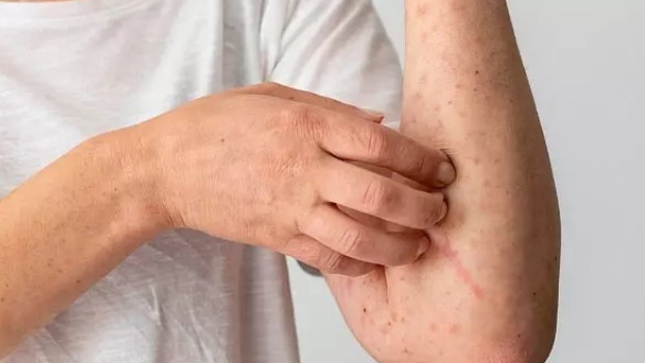 Foto - Kene ısırığıyla bulaşıyor: Ömür boyu et yemenizi engelleyebilir!